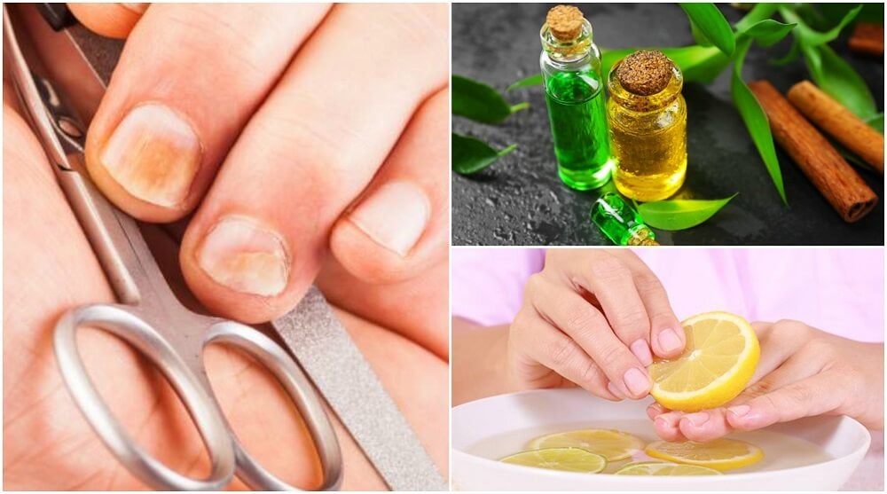 7 remedios caseros para los hongos de las uñas