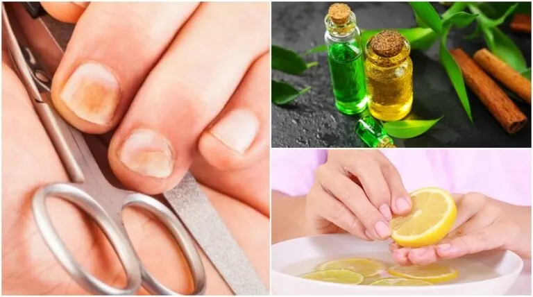 5 trucos caseros y fáciles para eliminar hongos y fortalecer las uñas