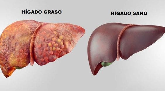 La betaína favorece la limpieza del hígado eliminando grasas del organismo