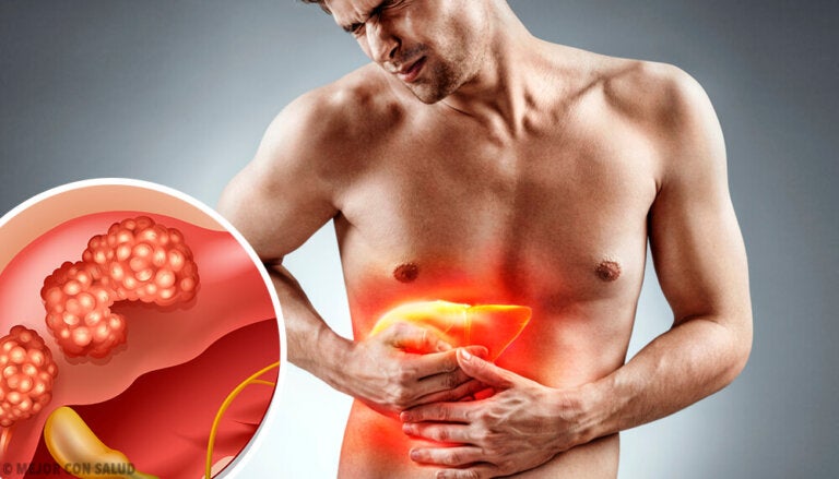 Cáncer de hígado: todo lo que debes saber