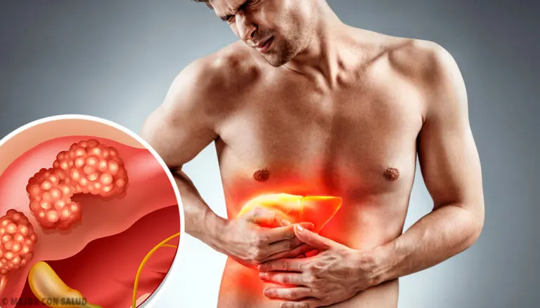 Cáncer de hígado: todo lo que debes saber