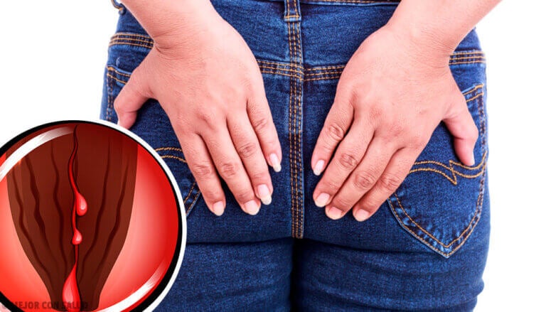 En qué consiste una fisura anal