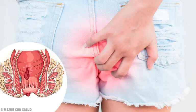 Fístula anal: todo lo que debes saber