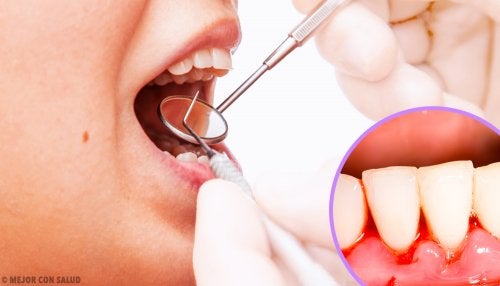 Cómo desinflamar las encías de forma definitiva – Estoclinic – Estética Dental en Terrassa