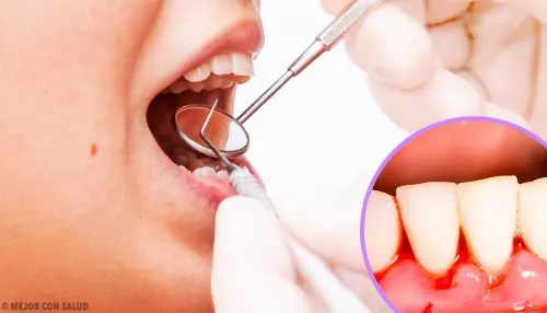 encías inflamadas