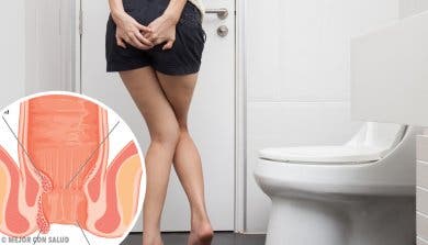 6 remedios caseros y naturales contra las hemorroides