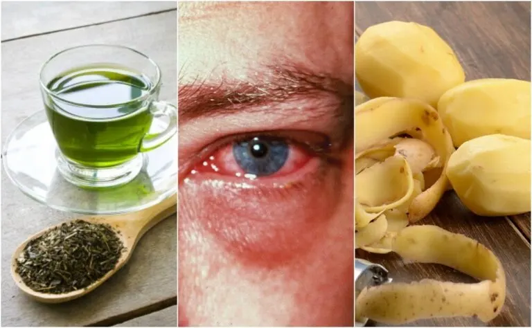 Los 9 mejores tips caseros para curar la conjuntivitis