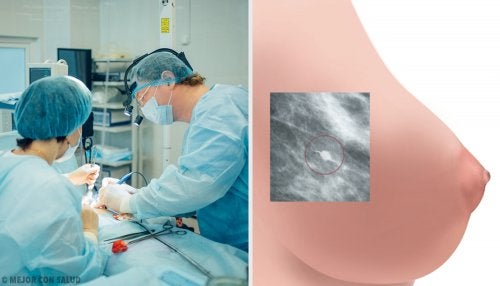 Operación de cáncer de mama
