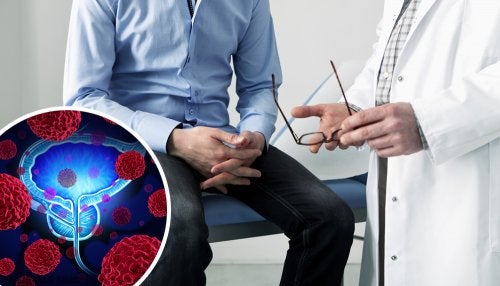 Primeros síntomas del cáncer de próstata
