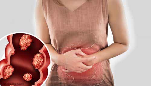 Síntomas de cáncer de colon