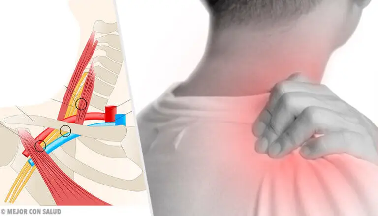 Síndrome de la salida torácica: todo lo que debes saber