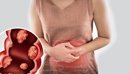 Síntomas de cáncer de colon