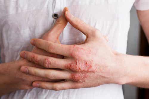 Hombre-afectado-por-eczema-en-manos