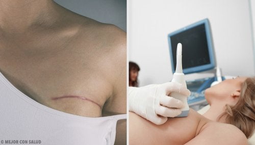 Tratamiento para el cáncer de mama
