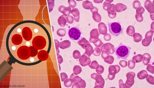 Técnicas de diagnóstico de leucemia linfocítica aguda