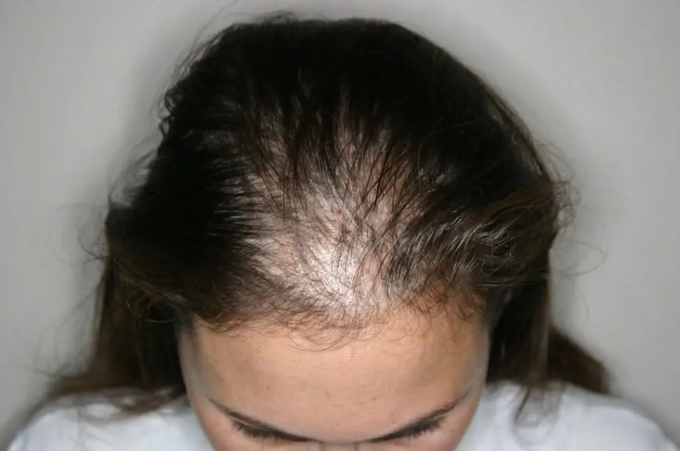 Alopecia