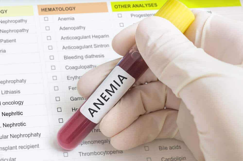 La anemia es una de las causas de la glositis.