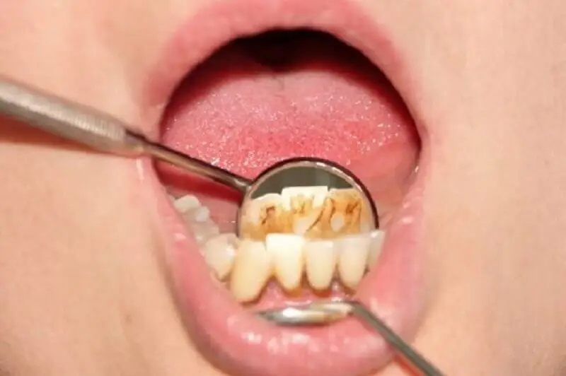 Persona con la boca abierta con sarro en los dientes.