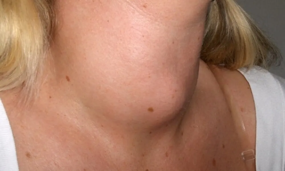bultos-cuello