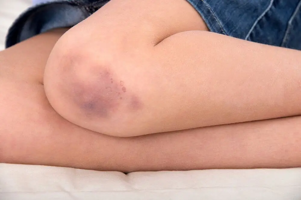 Contusión en las rodillas con hematoma.