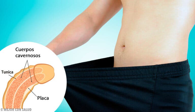 Enfermedad de Peyronie: todo lo que debes saber