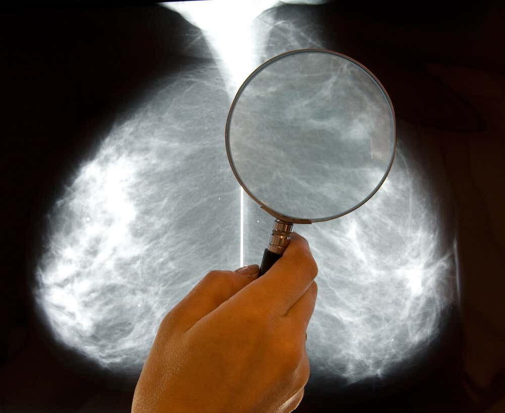Examen radiografía mama de paciente con cáncer de mama triple positivo