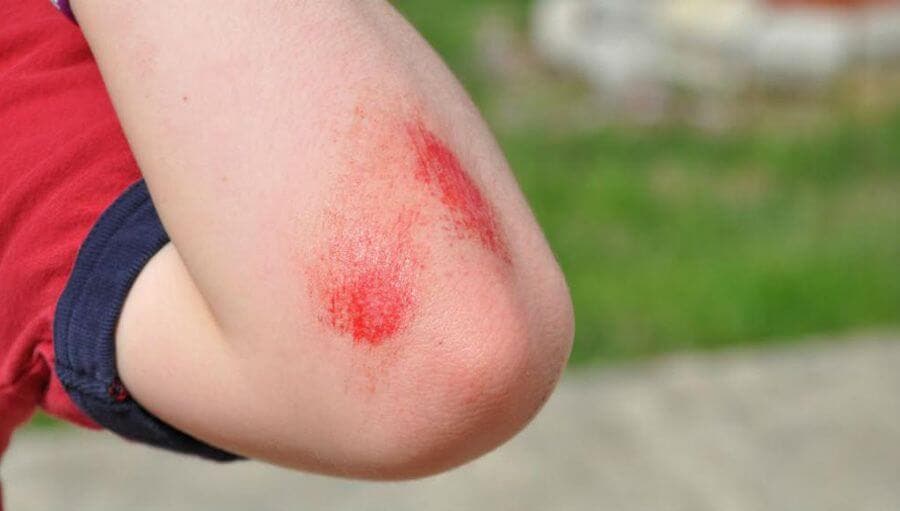 Jongen met beschadigde elleboog