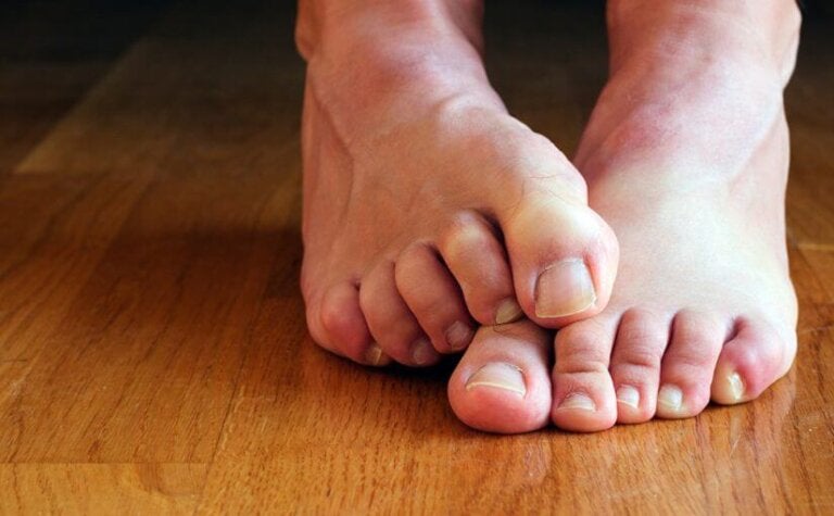 ¿Es posible eliminar los hongos de las uñas con remedios naturales?