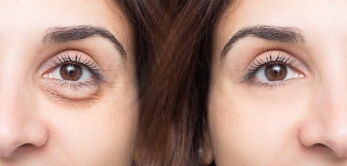 Mujer con ojeras