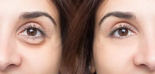 Mujer con ojeras