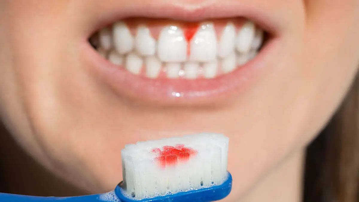 Sângerările din cauza gingivitei favorizează retragerea gingiilor