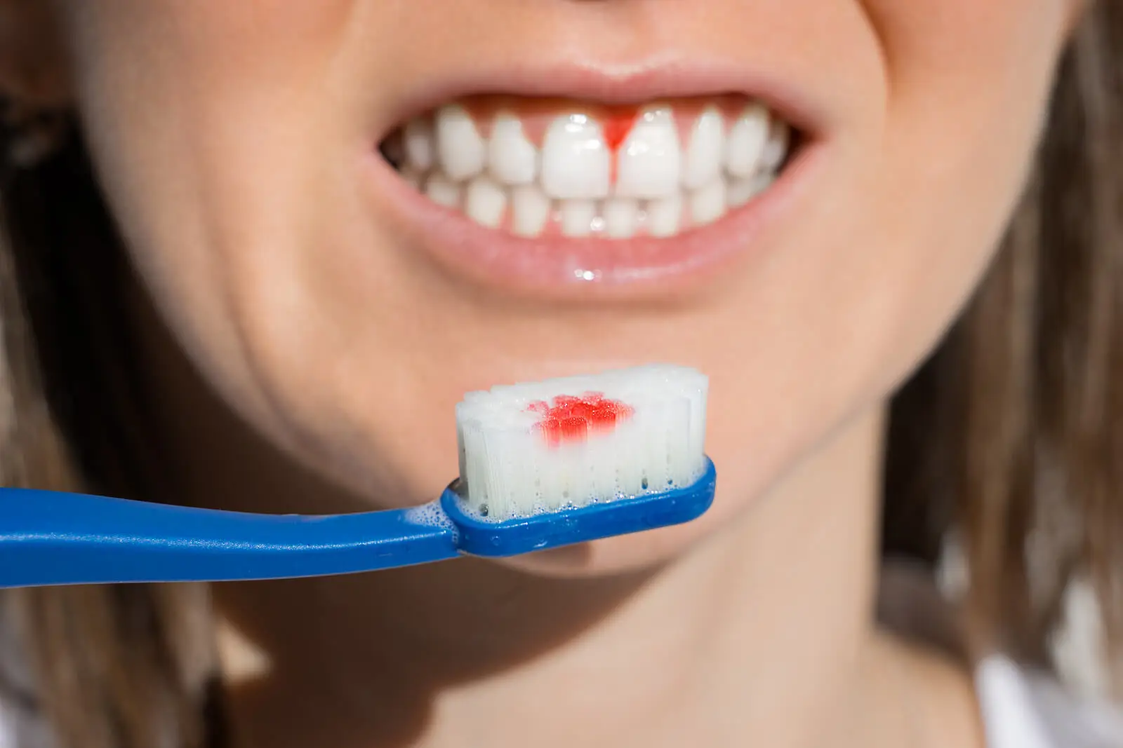 Tipos de hemofilia incluem hemofilia A