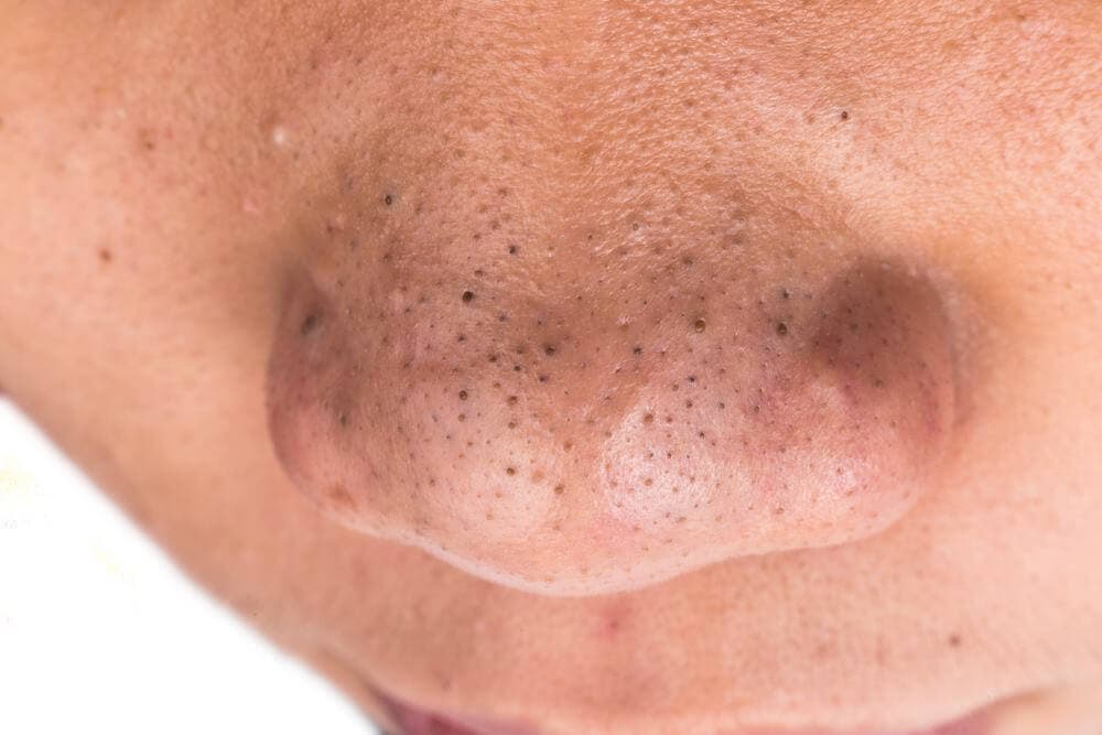 Puntos negros en el rostro.