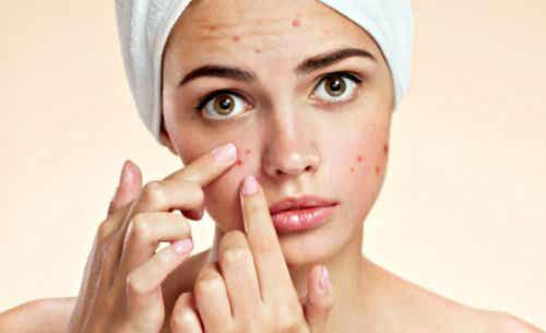 prevenir el acné