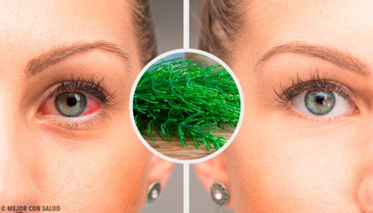6 recomendaciones para combatir la conjuntivitis de manera natural