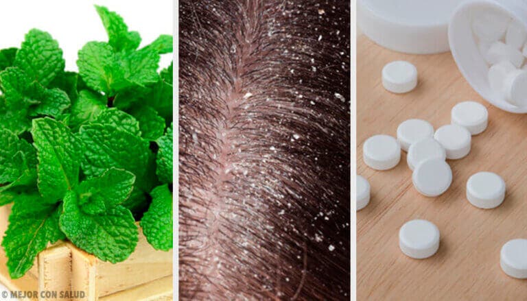 ¿Funcionan los remedios caseros para tratar la caspa?