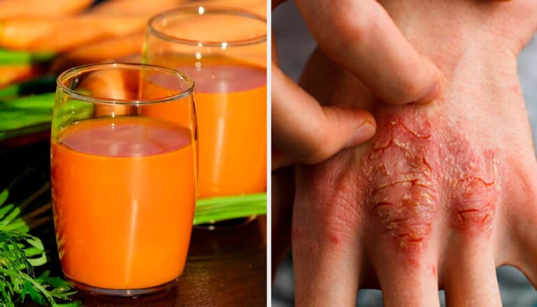 7 remedios naturales para prevenir y combatir la psoriasis