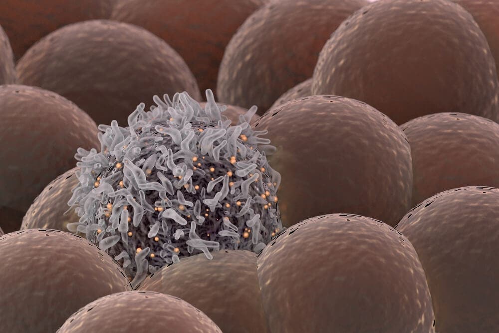 El cáncer de mama triple negativo