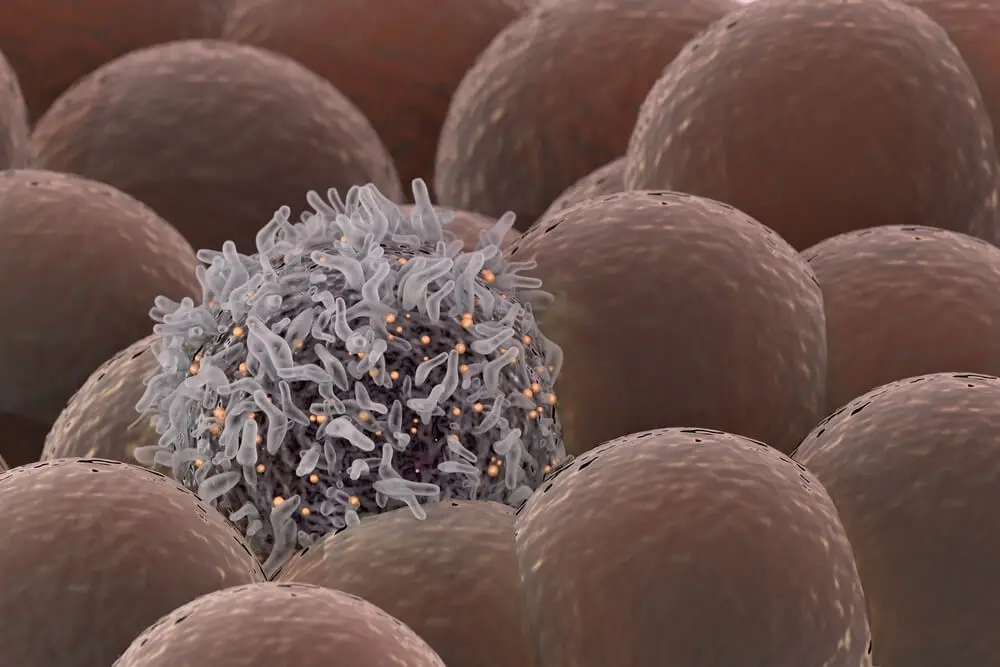 El cáncer de mama triple negativo