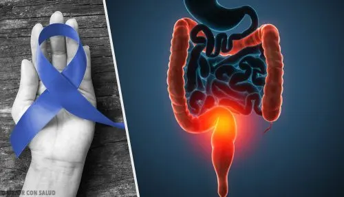 riesgo de cáncer de colon