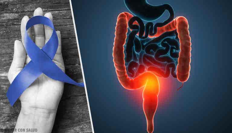 Principales causas del cáncer de colon