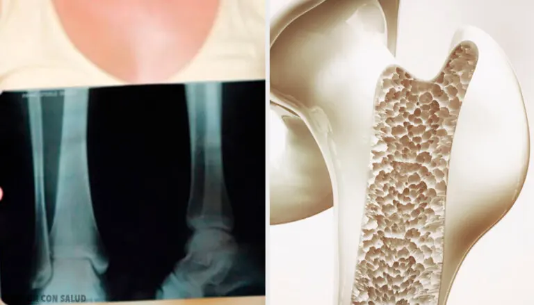 ¿Qué es la metástasis en los huesos?