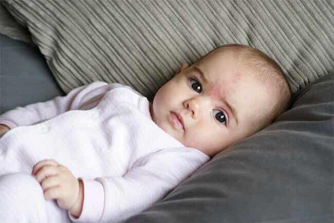 Síntomas de los angiomas en bebés