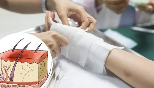 Brazo envuelto en gasas tras varias quemaduras en niños.