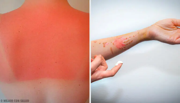 Tipos de quemaduras según su origen