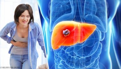 Todo lo que debes saber sobre el angioma hepático