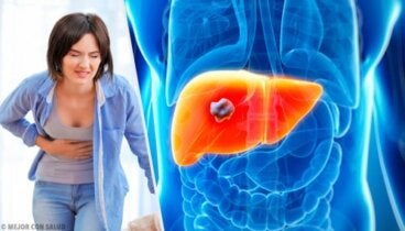 Todo lo que debes saber sobre el angioma hepático