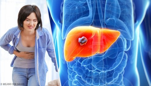 Todo lo que debes saber sobre el angioma hepático