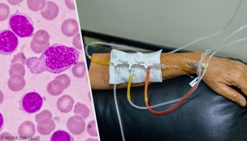 Tratamiento de la leucemia: presente y futuro
