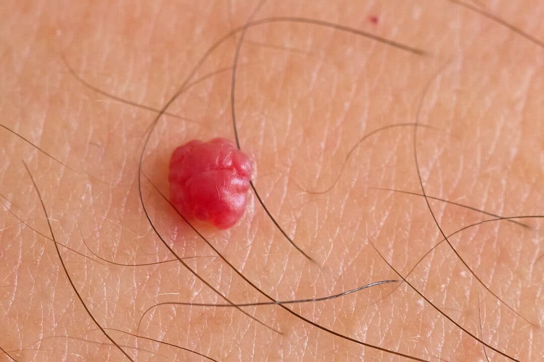 Angioma en adultos